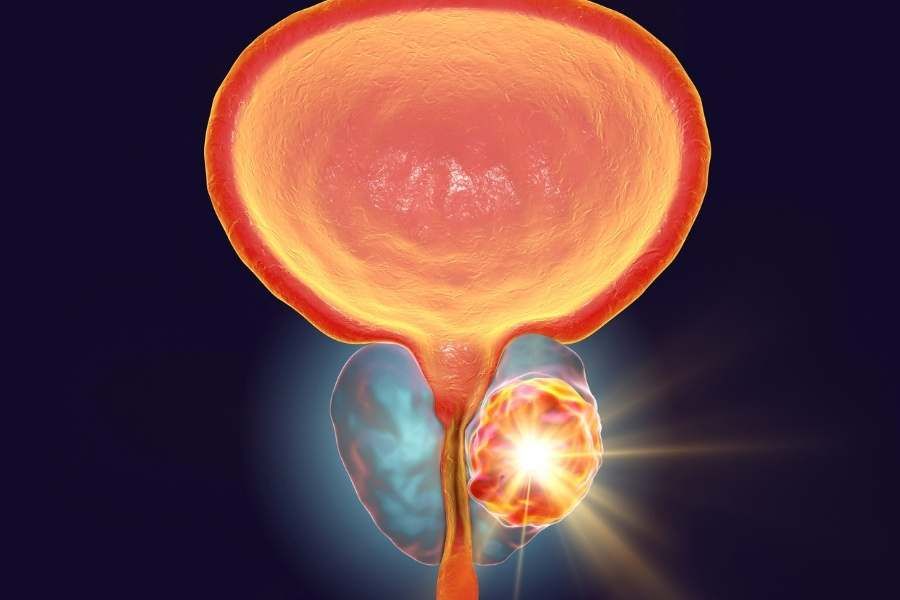 Darolutamide is approved by the USFDA for metastatic castration-sensitive prostate cancer