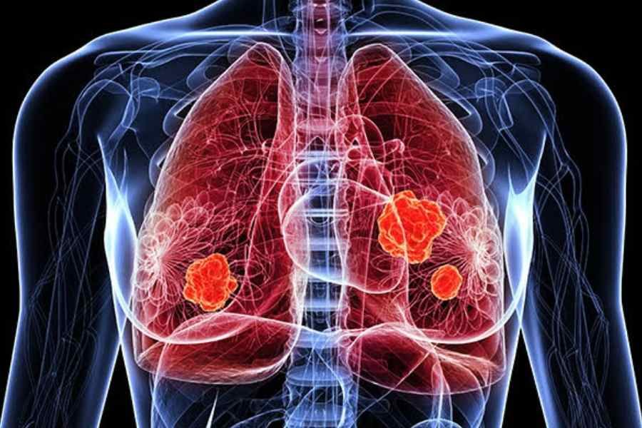 Datopotamab deruxtecan-dlnk is approved by the USFDA for EGFR-mutated non-small cell lung cancer