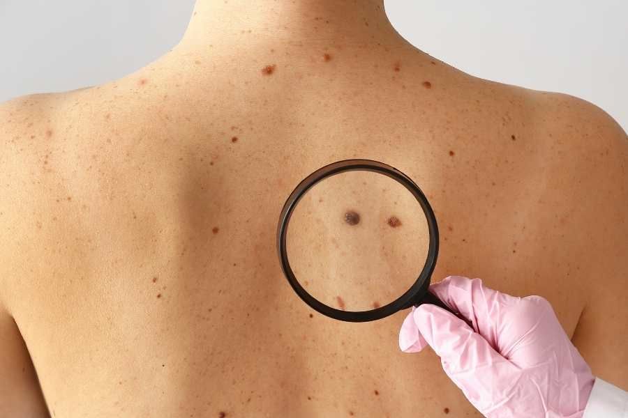 Lifileucel is approved by the USFDA for unresectable or metastatic melanoma