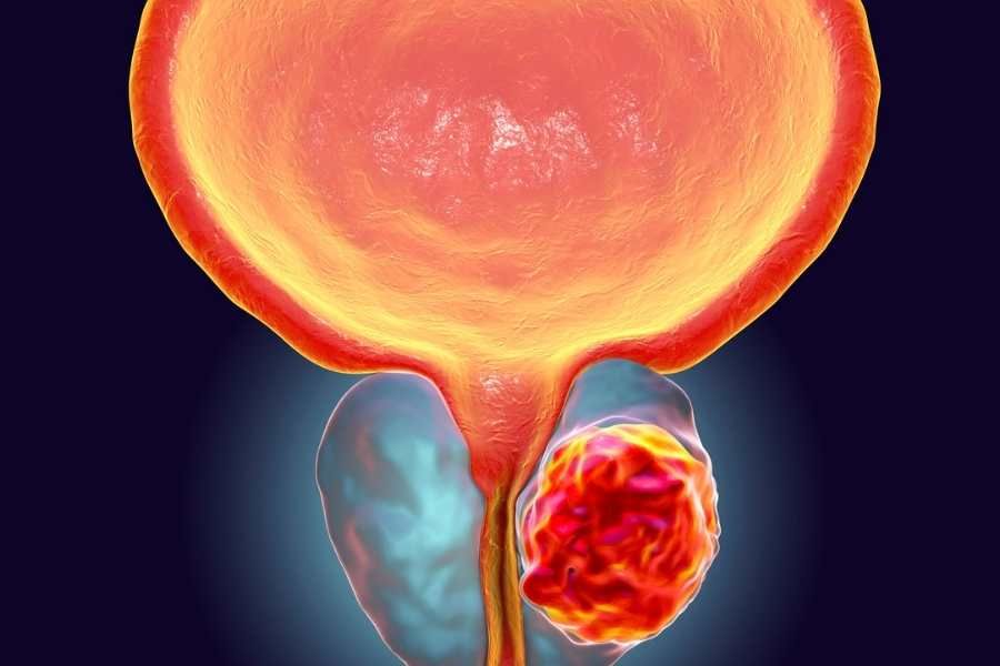 Nivolumab has been approved by the FDA for use as an adjuvant treatment for urothelial carcinoma