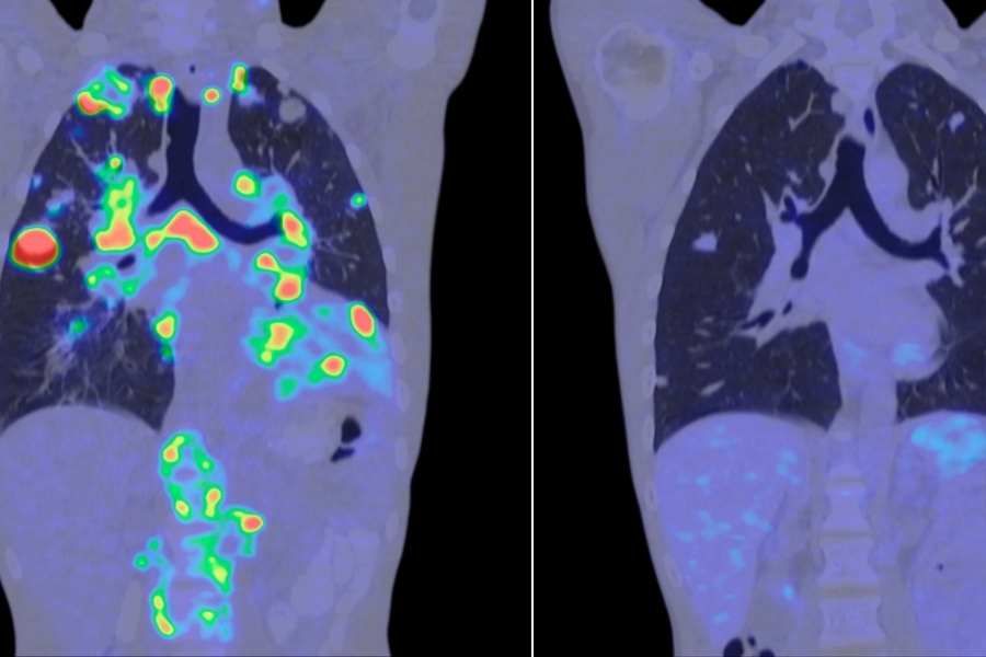 Taletrectinib is approved by the USFDA for ROS1-positive non-small cell lung cancer